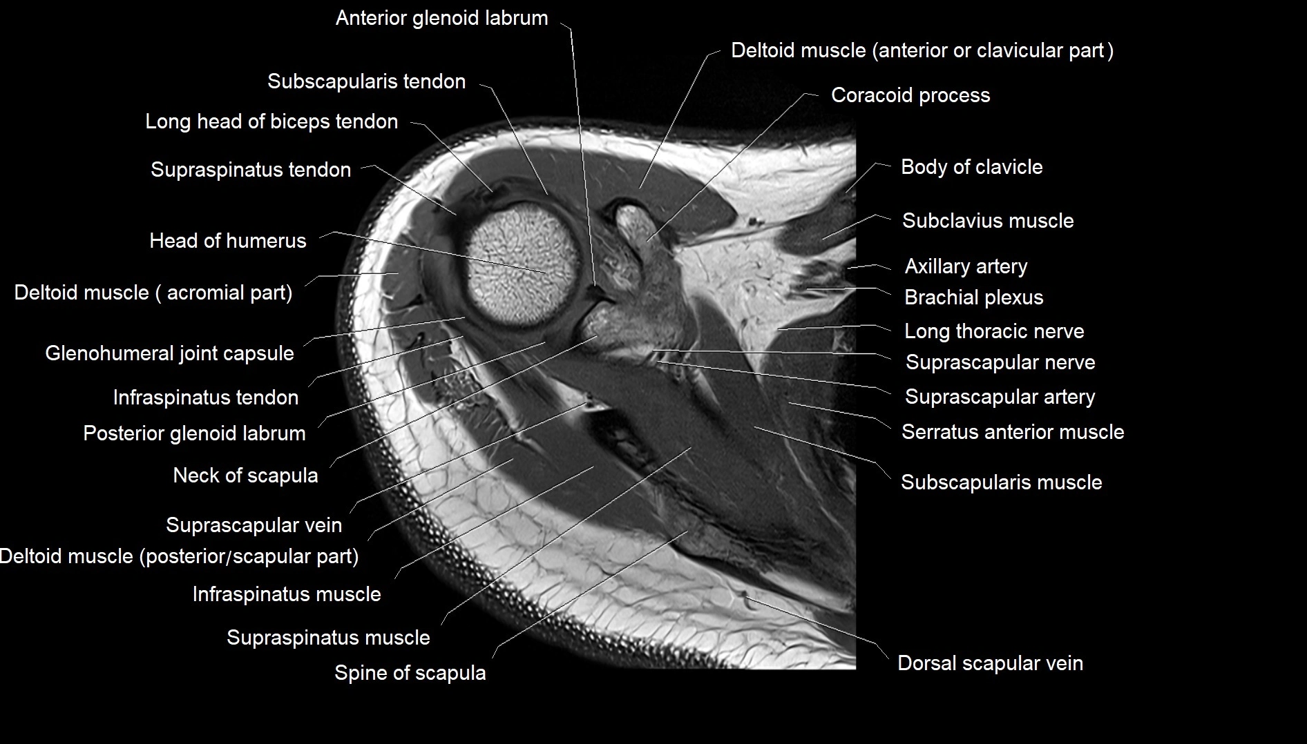 Shoulder cross sectional anatomy MRI 3T axial image 13.webp
